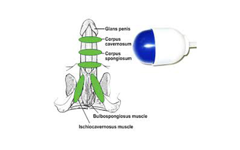 Disfunzione erettile